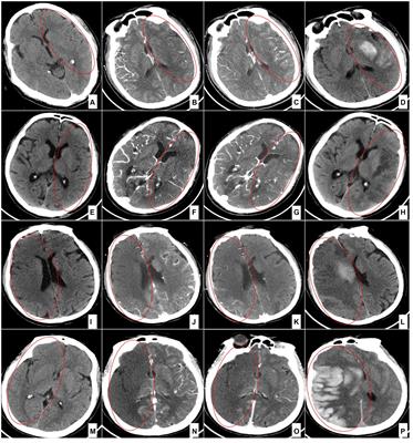 Rapid identification and prognosis evaluation by dual-phase computed tomography angiography for stroke patients with a large ischemic region in the anterior circulation treated with endovascular thrombectomy
